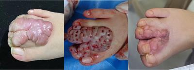 Successful treatment of Giant keloid on the right toes using trepanation combined with superficial radiotherapy (SRT-100): a case report with literature review